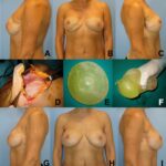 Breast Implants Rupture Mid-Flight: Shocking Incident