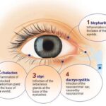 Eyelash in Eye: Relief & When to See a Doctor