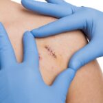 Nurses & Wound Care: Suturing Minor Injuries