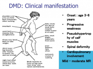 Son’s Awkward Gait? Causes & When to Seek Help