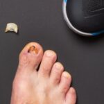 Toenail Fell Off? See a Podiatrist Before a Pedicure