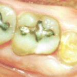 Wisdom Teeth Extraction: When & Alternatives