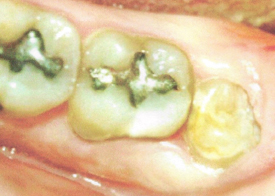 Wisdom Teeth Extraction: When & Alternatives